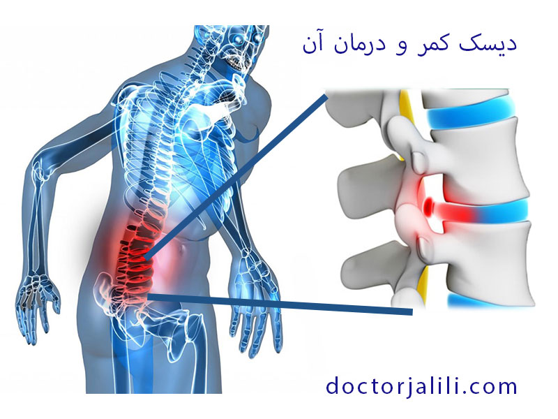 دیسک کمر شدید و درمان آن بدون جراحی!