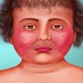 همه-چیز-درباره-سندروم-کوشینگ
